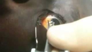 Eye Injection Procedure | Patient 2