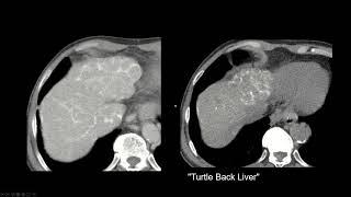 Interpreting CT Abdo: Cirrhosis, Portal Hypertension, Schistosomiasis