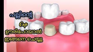 പല്ലിന്റെ cap ഊരിപോയാൽ ഇങ്ങനെ ചെയ്യു | dentaltalk by Dr Ajina Salim