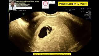 Missed Abortion 10 weeks