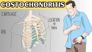 Costochondritis - Causes, Signs And Symptoms, Diagnosis, And Treatment