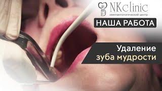 Удаление зуба мудрости в NKclinic