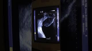 HYPOPLASTIC UTERUS DIDEDPHYS with HEMATOMETRA in RT