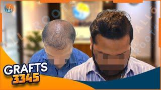 Hair Transplant Results | 3345 Grafts transplanted | Dr Alok Sahoo | Alloroots