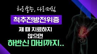 '척추전방전위증' 제 때 치료하지 않으면 하반신 마비까지 생길 수 있다.. 허리통증, 다리저림 의심 신호 [ 메디컬다큐365 ] 20240930