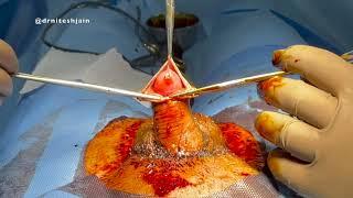 Circumcision - Where in the preputial / Foreskin Skin is removed done for Phimosis/ Religious belief