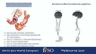 Bariatric and Metabolic Endoscopy: A New Management Paradigm | IFSO 2024