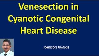 Venesection in Cyanotic heart Disease