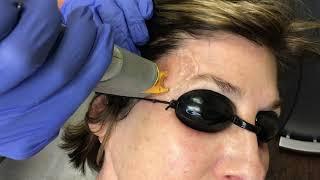 Nd:YAG Laser – Torrey Pines Dermatology