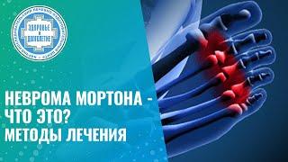    Неврома Мортона - что это? Методы лечения