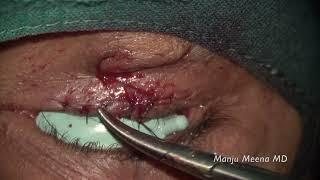 Lower eyelid notch repair by Dr Manju Meena