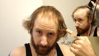 BALDING MAN Shaves Head Bald TOTALLY TRANSFORMING His Look!