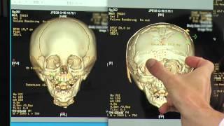 Craniosynostosis: Treatment Options for Metopic & Unilateral Coronal Synostosis | Part 6 of 6