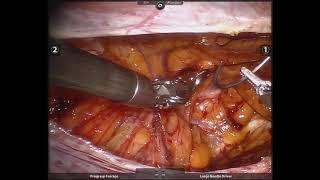 Left Robotic TAPP For Pantaloon Inguinal Hernia, Dr Hector Valenzuela. Doctor Hernia.