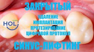 Закрытый синус-лифтинг, удаление и имплантация, протезирование и цифровой протокол.