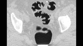 virtual colon: Stool impacted in diverticulum. CASE64A.avi