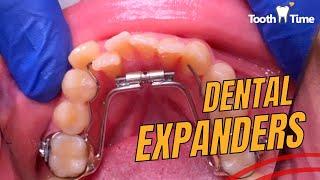 How to turn a dental expander - Full video - Braces On - Toothtime  New Braunfels #dentist