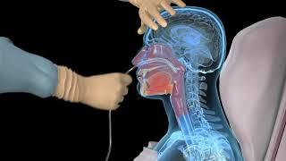 How to insert a nasogastric tube for NG intubation - 3d animation