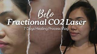 BELO Fractional CO2 Laser Healing Process | DOES IT REALLY WORK? (what you should expect and cost)