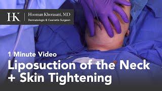 Liposuction of the Neck & Skin Tightening in 1 min by Dr. Hooman Khorasani