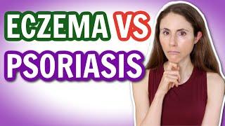 ECZEMA VS PSORIASIS: HOW TO TELL THE DIFFERENCE  @DrDrayzday