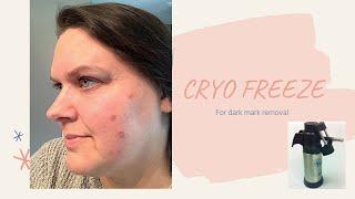 CRYO FREEZE, Getting rid of dark marks!! Does this work?? Liquid nitrogen.