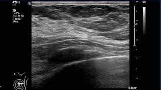 Breast Ultrasound - normal anatomy