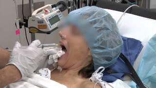 A technique of awake intubation from AOD