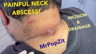 Painful neck abscess drained. 7 day follow up at end of video. Acid base shift, deep loculations.