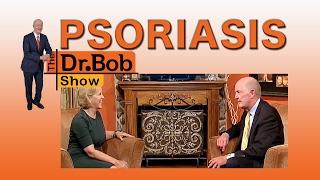 Treatments For Psoriasis