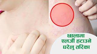 Skin Care Tips allergy in Nepali