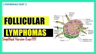 Follicular lymphoma | Lymphomas Made Easy | Speedy Medical