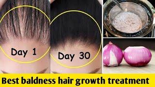 இனி முடியும் கொட்டாது கொட்டுன முடியும் திரும்ப வளரும் | Baldness repair hair pack ENGLISH subtitle​