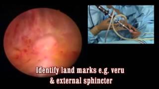 Bipolar turp 5 How to check landmarks assess prostate and stabilize resectoscope sheath