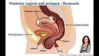 What is Posterior Vaginal Wall Prolapse?