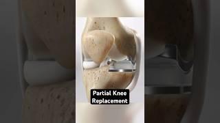 Partial Knee Replacement (3D Animation)