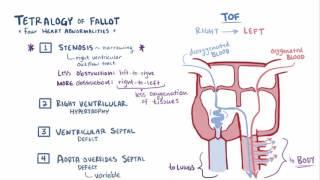 Tetralogy of fallot TOF   repair, causes, symptoms & pathology