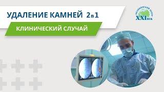 Удаление камней из почки (2 операции в одной) | Медицинский центр 21 век #медицинскийцентр21век