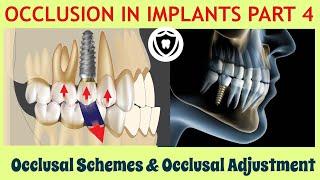 Occlusion in Implants Part 4. Occlusal schemes & Occlusal adjustment.