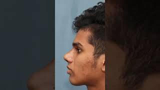 Best Result After Rhinoplasty In India | Before & After Results | Dr Mathew PC #shorts