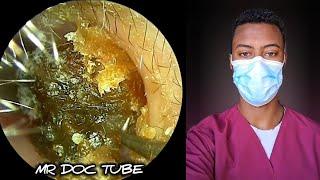 Watch This Epic Ear Wax Extraction - So Gross, Yet So Satisfying!#2025 #ear #new