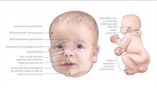 Noonan syndrome