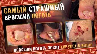 Самый страшный вросший ноготь/ Вросший ноготь после хирурга в Китае #китай #хирург #подолог #вросший