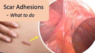 Scar Adhesion Symptoms, Pain, Prevention and Treatment.