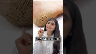 How to treat cracked heels | Cracked heels treatment | Foot cream for cracked heels