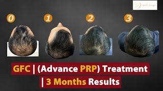 GFC Hair Treatment Is Getting Popular As Compared To PRP | 3 Months Amazing Result