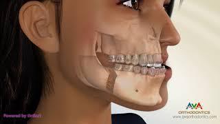 Surgical Orthodontic Treatment for Underbite or Crossbite - Transcortical Mandibular Setback