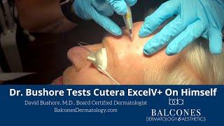 Dermatologist Dr David Bushore Tests Cutera ExcelV+ On Himself | Austin, Texas | Ph: 512-459-4869