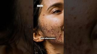 2 Types of Acne | Inflammatory Acne vs Noninflammatory Acne