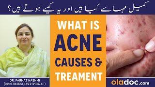 Acne Kya Hai? - Acne Treatment - Pimple Removal - Ek Raat Mein Acne Khatam Kren - Easy Acne Remedies